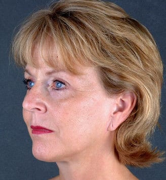 blepharoplasty - patient 5389 - after 2 blepharoplasty - patient 5389 - after 2