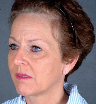 blepharoplasty - patient 5389 - before 2 blepharoplasty - patient 5389 - before 2
