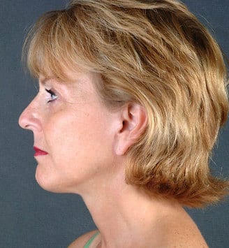 blepharoplasty - patient 5389 - after 3 blepharoplasty - patient 5389 - after 3