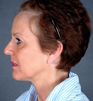 blepharoplasty - patient 5389 - before 3 blepharoplasty - patient 5389 - before 3