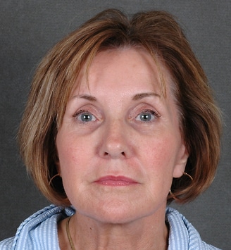 blepharoplasty - patient 5360 - before 1 blepharoplasty - patient 5360 - before 1