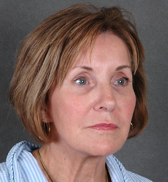 blepharoplasty - patient 5360 - before 2 blepharoplasty - patient 5360 - before 2