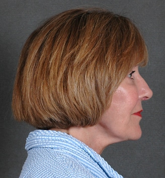 blepharoplasty - patient 5360 - after 3 blepharoplasty - patient 5360 - after 3