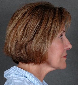blepharoplasty - patient 5360 - before 3 blepharoplasty - patient 5360 - before 3