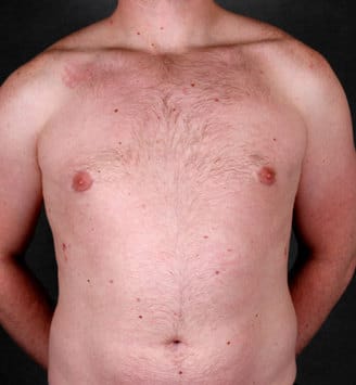 gynecomastia - patient 6060 - after 1 gynecomastia - patient 6060 - after 1