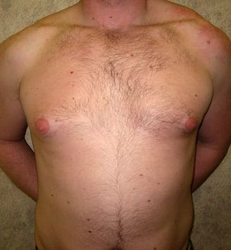 gynecomastia - patient 6060 - before 1 gynecomastia - patient 6060 - before 1