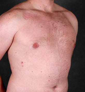 gynecomastia - patient 6060 - after 2 gynecomastia - patient 6060 - after 2
