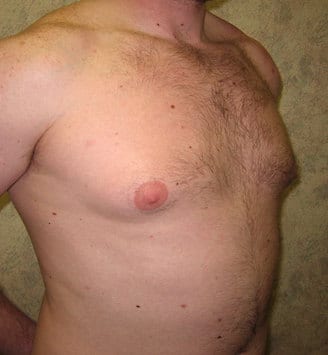 gynecomastia - patient 6060 - before 2 gynecomastia - patient 6060 - before 2