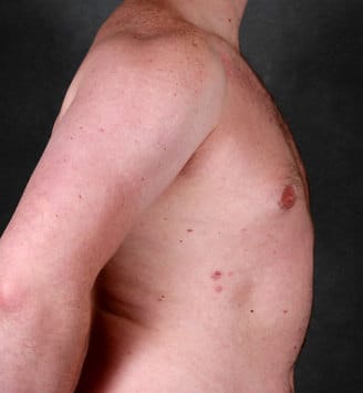 gynecomastia - patient 6060 - after 3 gynecomastia - patient 6060 - after 3
