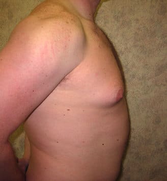 gynecomastia - patient 6060 - before 3 gynecomastia - patient 6060 - before 3