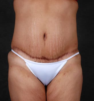 liposuction - patient 4239 - after 1 liposuction - patient 4239 - after 1