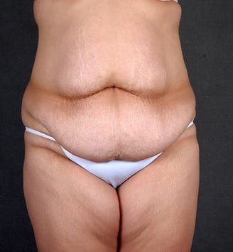 liposuction - patient 4239 - before 1 liposuction - patient 4239 - before 1