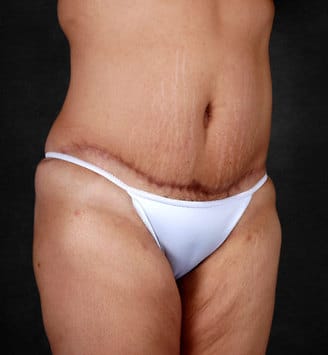 liposuction - patient 4239 - after 2 liposuction - patient 4239 - after 2