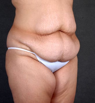liposuction - patient 4239 - before 2 liposuction - patient 4239 - before 2