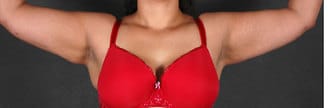 liposuction - patient 4239 - after 4 liposuction - patient 4239 - after 4
