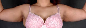 liposuction - patient 4239 - before 4 liposuction - patient 4239 - before 4