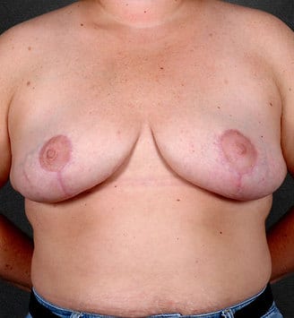 breast reduction - patient 5987 - after 1 breast reduction - patient 5987 - after 1