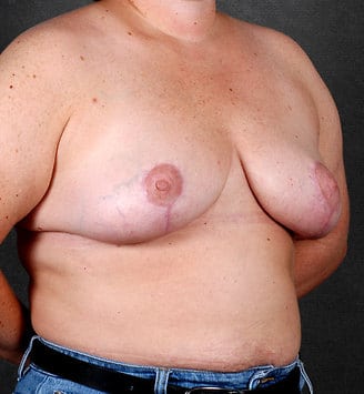 breast reduction - patient 5987 - after 2 breast reduction - patient 5987 - after 2