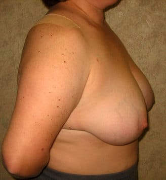 breast reduction - patient 5987 - before 3 breast reduction - patient 5987 - before 3