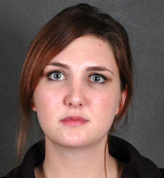 rhinoplasty - patient 5825 - after 1 rhinoplasty - patient 5825 - after 1