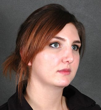 rhinoplasty - patient 5825 - after 2 rhinoplasty - patient 5825 - after 2