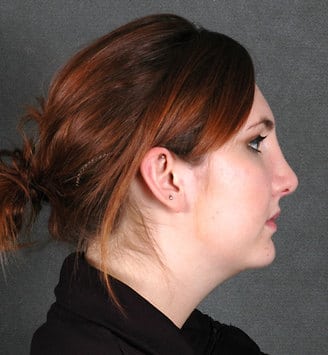 rhinoplasty - patient 5825 - after 3 rhinoplasty - patient 5825 - after 3