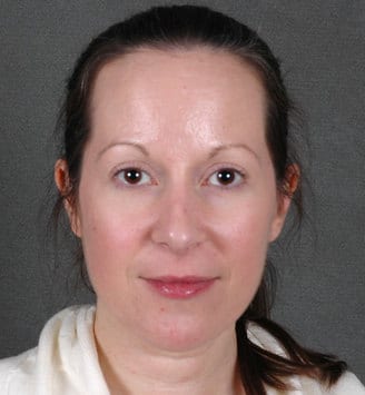 blepharoplasty - patient 5450 - after 1 blepharoplasty - patient 5450 - after 1