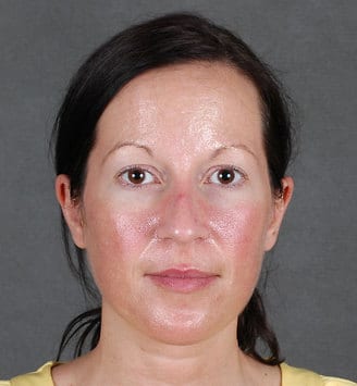 blepharoplasty - patient 5450 - before 1 blepharoplasty - patient 5450 - before 1