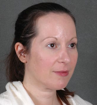 blepharoplasty - patient 5450 - after 2 blepharoplasty - patient 5450 - after 2