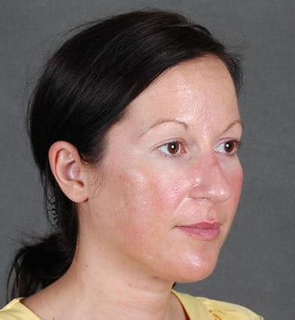 blepharoplasty - patient 5450 - before 2 blepharoplasty - patient 5450 - before 2