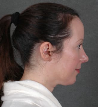 blepharoplasty - patient 5450 - after 3 blepharoplasty - patient 5450 - after 3