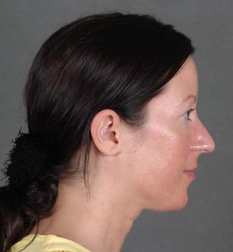 blepharoplasty - patient 5450 - before 3 blepharoplasty - patient 5450 - before 3