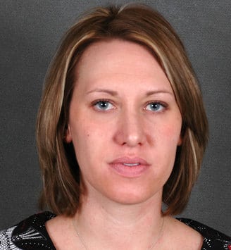 rhinoplasty - patient 5951 - after 1 rhinoplasty - patient 5951 - after 1