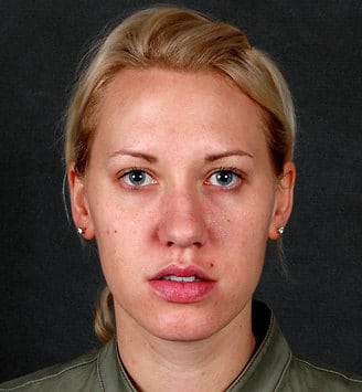 rhinoplasty - patient 5951 - before 1 rhinoplasty - patient 5951 - before 1