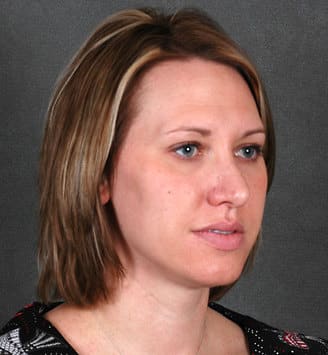 rhinoplasty - patient 5951 - after 2 rhinoplasty - patient 5951 - after 2