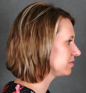 rhinoplasty - patient 5951 - after 3 rhinoplasty - patient 5951 - after 3