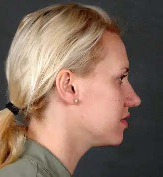 rhinoplasty - patient 5951 - before 3 rhinoplasty - patient 5951 - before 3