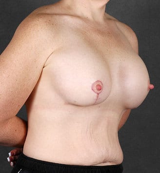 breast augmentation - patient 5118 - after 2 breast augmentation - patient 5118 - after 2