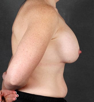 breast augmentation - patient 5118 - after 3 breast augmentation - patient 5118 - after 3