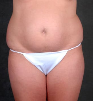 breast lift - patient 5697 - before 4 breast lift - patient 5697 - before 4