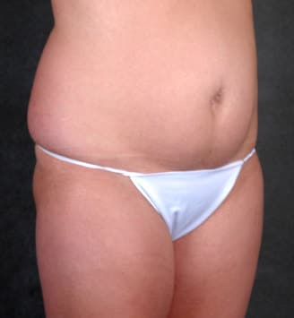 breast lift - patient 5697 - before 5 breast lift - patient 5697 - before 5