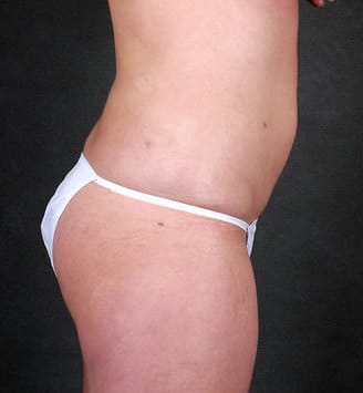 liposuction - patient 4226 - after 6 liposuction - patient 4226 - after 6