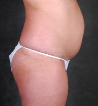 liposuction - patient 4226 - before 6 liposuction - patient 4226 - before 6