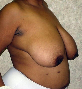 breast reduction - patient 6040 - before 2 breast reduction - patient 6040 - before 2