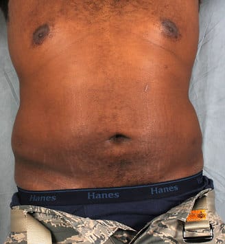 liposuction - patient 4185 - after 1 liposuction - patient 4185 - after 1