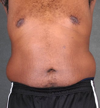 liposuction - patient 4185 - before 1 liposuction - patient 4185 - before 1