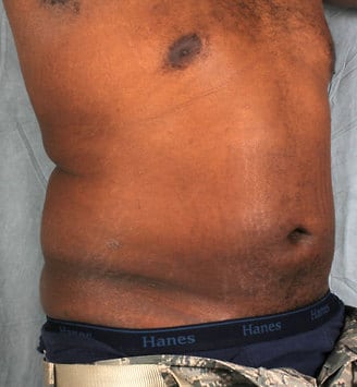 liposuction - patient 4185 - after 2 liposuction - patient 4185 - after 2