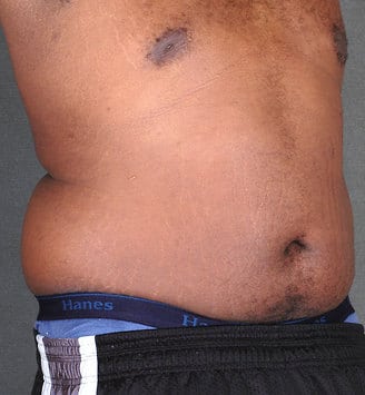 liposuction - patient 4185 - before 2 liposuction - patient 4185 - before 2