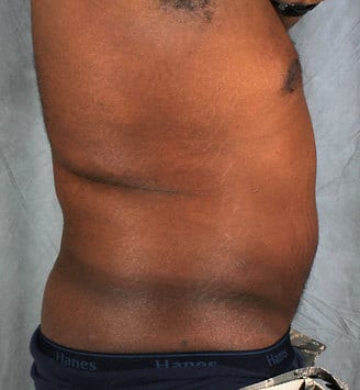 liposuction - patient 4185 - after 3 liposuction - patient 4185 - after 3