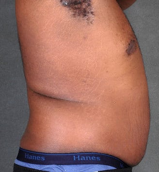 liposuction - patient 4185 - before 3 liposuction - patient 4185 - before 3